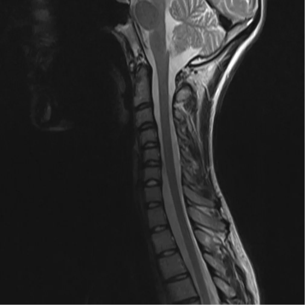Cervical Spine MRI in St. Louis