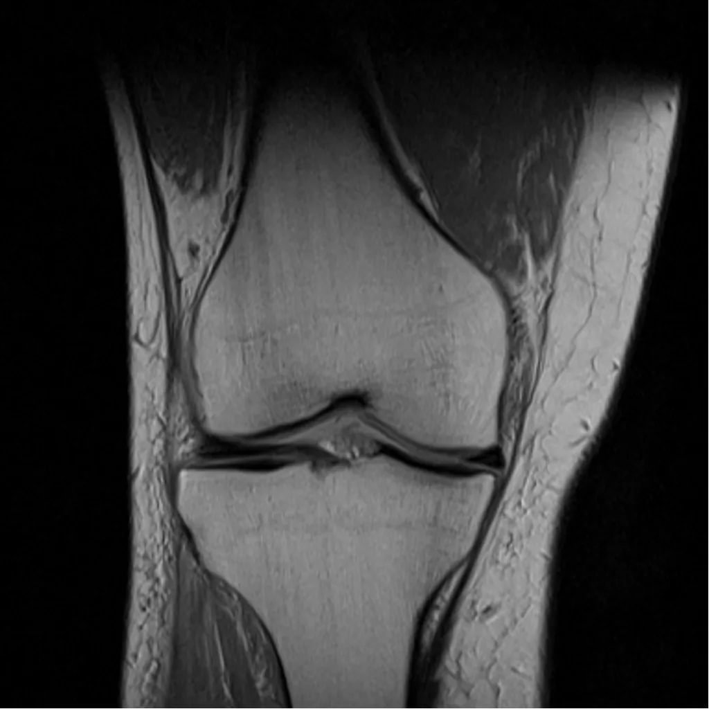 What Does a Knee MRI Show?