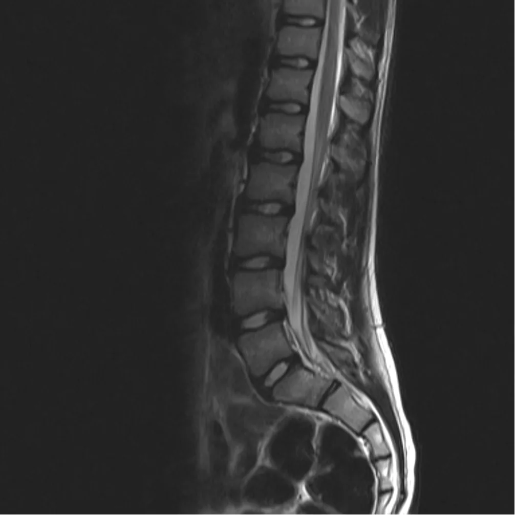 Lumbar Spine MRI: What It Shows