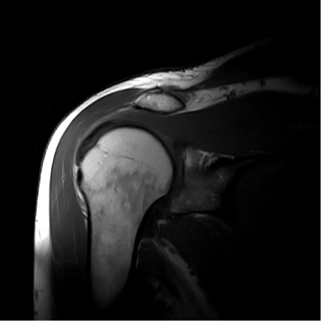 Why a Shoulder MRI Costs $399