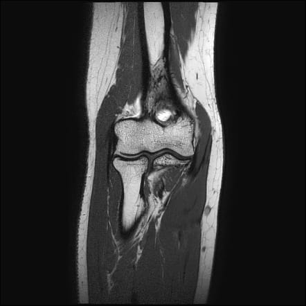 elbow mri