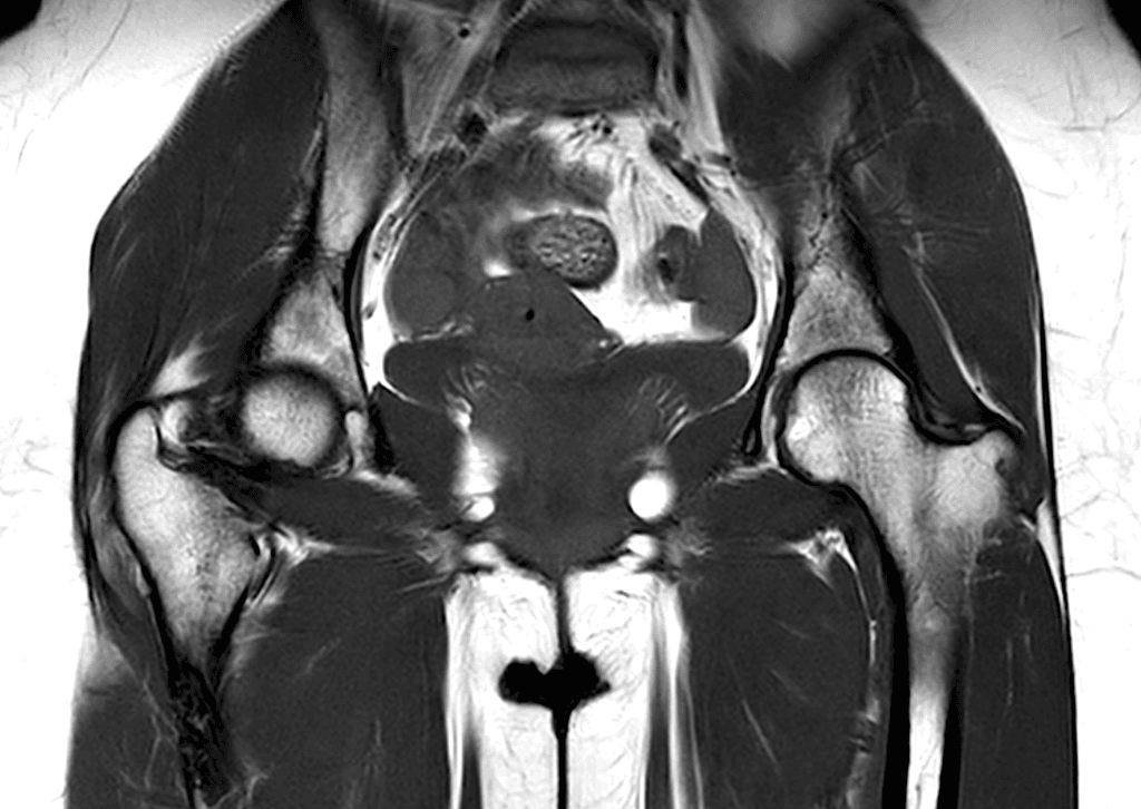 hip mri
