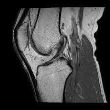 knee mri