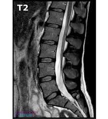 lumber spine mri
