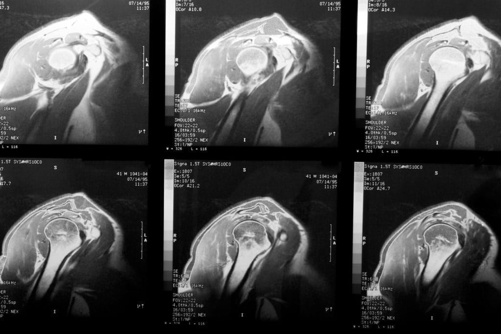 mri of rotator cuff