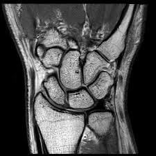 wrist mri