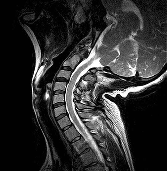 Cervical spine mri