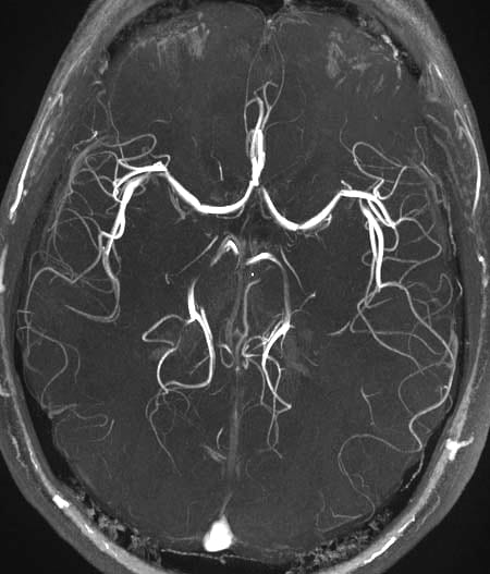 Mra head (veins)