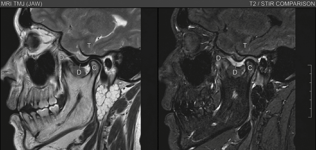 tmj (jaw joint)